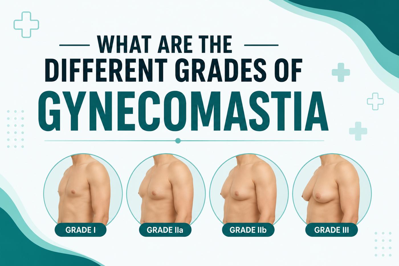 What are the different grades of gynecomastia showing Grade I, Grade IIa, Grade IIb, and Grade III